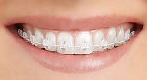 Orthodontics Braces Bonita Springs FL SMILE Dental