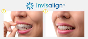 Invisalign Instructions