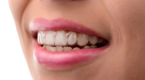 clear aligners on smiling girl