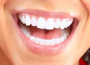 Woman Smiling with Veneers