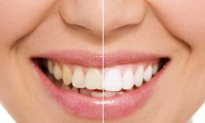 Dental Bonding Before & After