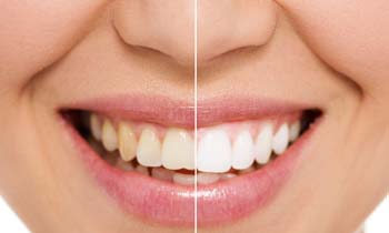 Dental Bonding Before & After