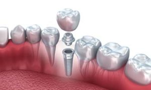 Dental Implants