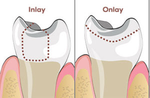 dental inlay and onlay