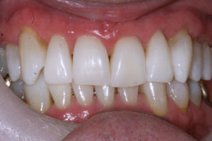KoR Whitening After Treatment