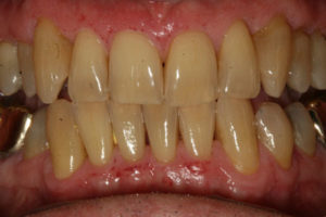 KoR Whitening Before Stained Teeth